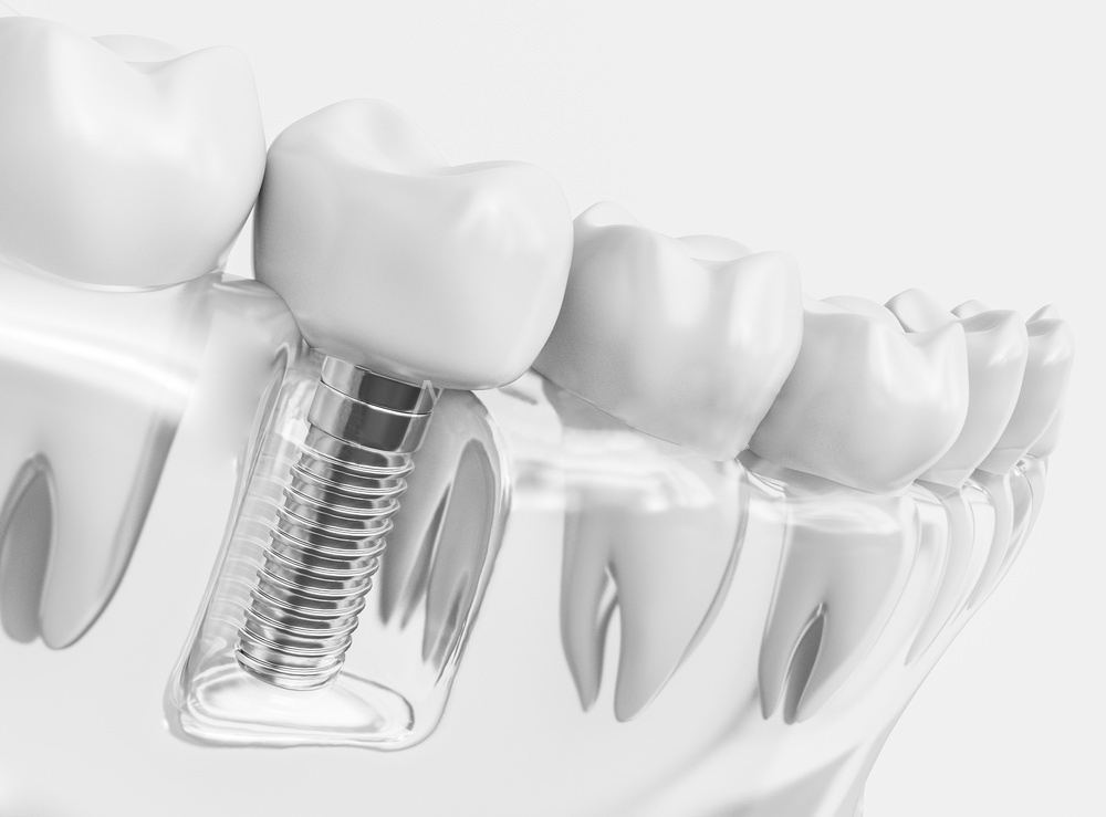 Dental Design - Qualitätsmanagement im zahntechnischen Bereich